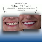 Before-After-Emax-Crown