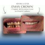 Before-After-Emax-Crown-2