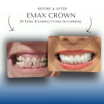 Before-After-Emax-Crown-4