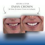 Before-After-Emax-Crown-5