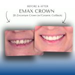 Before-After-Emax-Crown-6