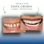 Before-After-Emax-Crown3