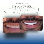 Before-After-Emax-Veneer