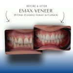 Before-After-Emax-Veneer-2