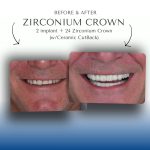Before-After-Implant and Zirconium-Crown