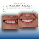 Before-After-Zirconium-Crown.