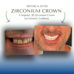Before-After-Zirconium-Crown