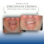 Before-After-Zirconium-Crown-2
