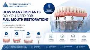 how many implants for full mouth restoration yeditepe