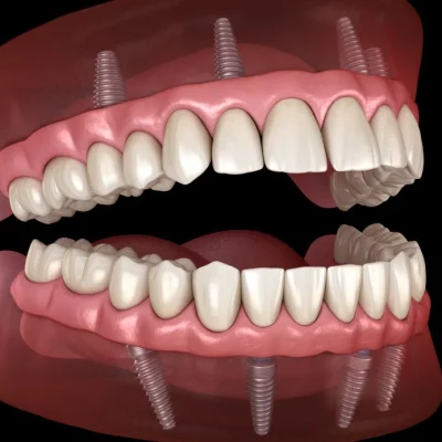 all-on-4-dentaş-implants