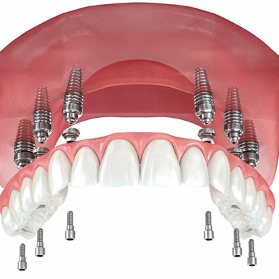all-on-6-dental-implant-yeditepe