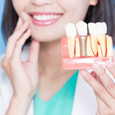dental-implants-after-care