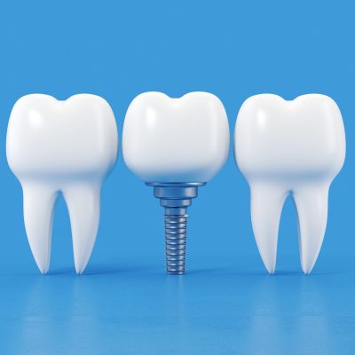 dental implants