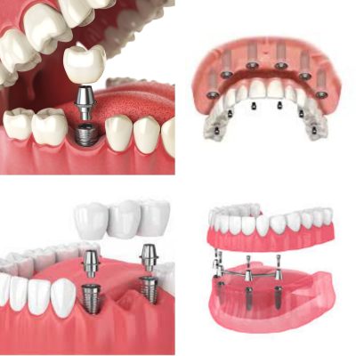 types of dental implants